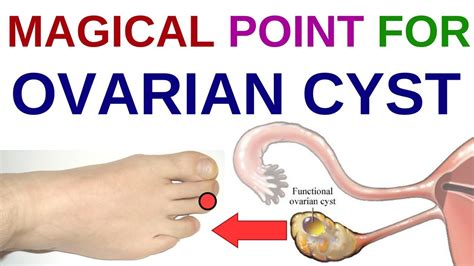 Cause of PCOS or PCOD is not known but researchers believe that poor diet, reduced physical activity and unhealthy lifestyle is the main culprit behind it. . Acupressure points for ovary cyst